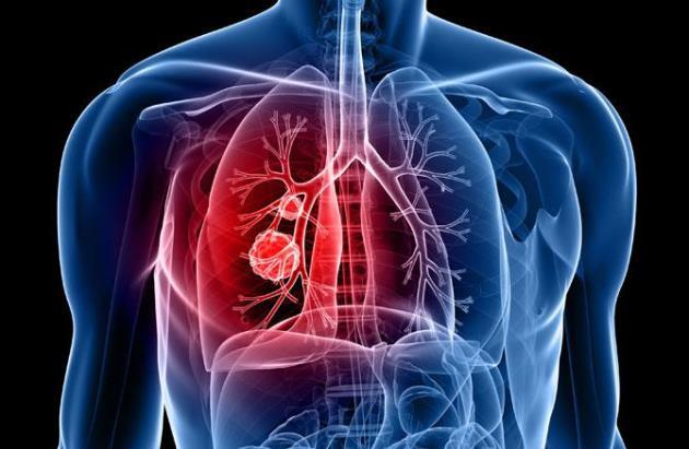 Παγκόσμια Ημέρα κατά της Χρόνιας Αποφρακτικής Πνευμονοπάθειας: Προσφορά προληπτικού ελέγχου από τον Όμιλο Ιατρικού Αθηνών